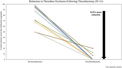 Single-center experience with the ClotTriever BOLD catheter for deep vein thrombosis percutaneous mechanical thrombectomy of the lower extremity